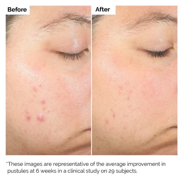 The Ordinary Salicylic Acid 2% Exfoliating Blemish Solution - Image 3